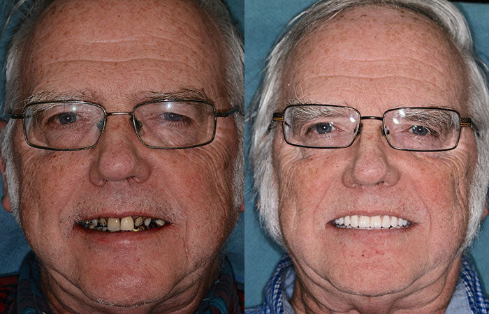 Prótesis dentales completas personalizadas LumaDent — Marfil y blanco, ajuste personalizado - Desfino