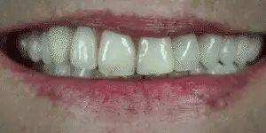 Facetas dentárias removíveis NovaSmile de encaixe para dentes superiores e inferiores - Desfino