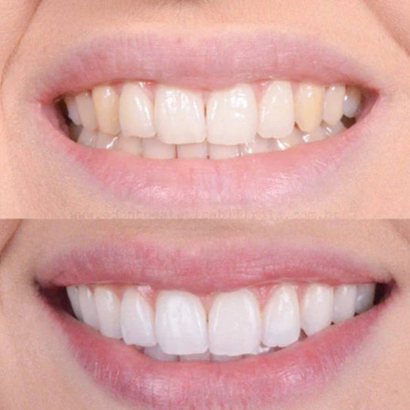 Swift Teeth Whitening Treatment — Quick Visible Stain Removal - Desfino