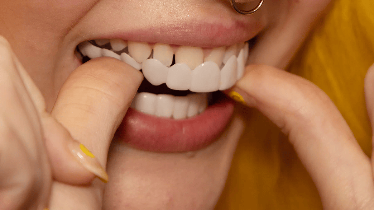 Facetas dentárias removíveis NovaSmile de encaixe para dentes superiores e inferiores - Desfino