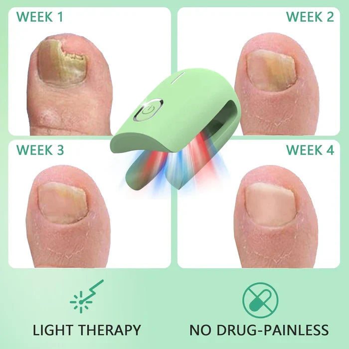 Dispositivo de terapia laser para unhas com três comprimentos de onda — 905nm, 660nm e 470nm - Desfino