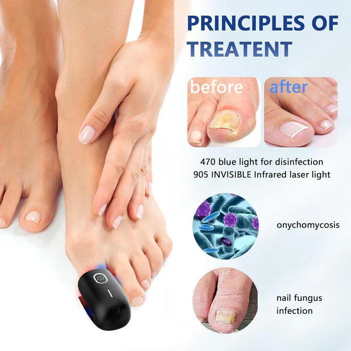 Dispositivo de terapia laser para unhas com três comprimentos de onda — 905nm, 660nm e 470nm - Desfino