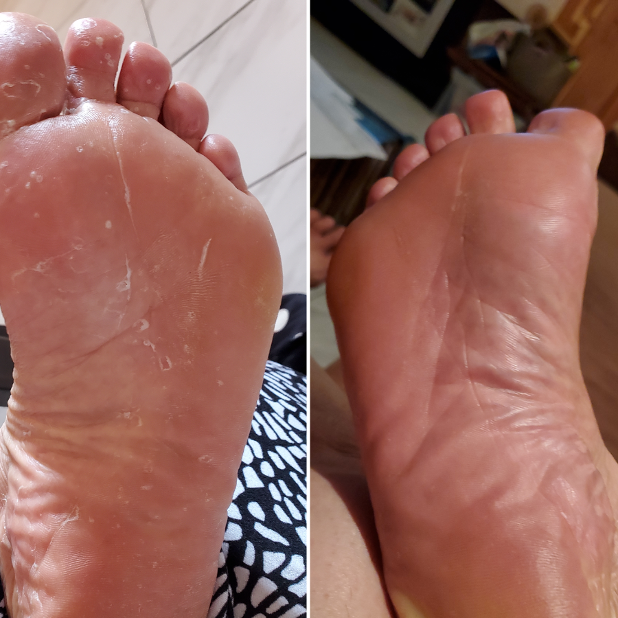 Barra de limpeza antifúngica para pele irritada e alívio da comichão na virilha - Desfino