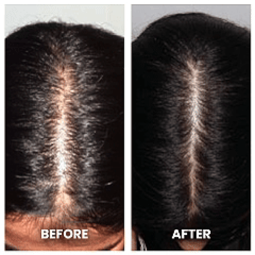 REGENVIE Pro Hair Renewal System — FDA-Cleared Laser Therapy - Desfino