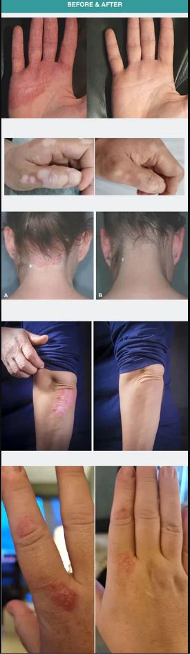 Kompakte 308-nm-UVB-Phototherapielampe — 3 austauschbare Lampenschirme, einstellbare Behandlungsbereiche