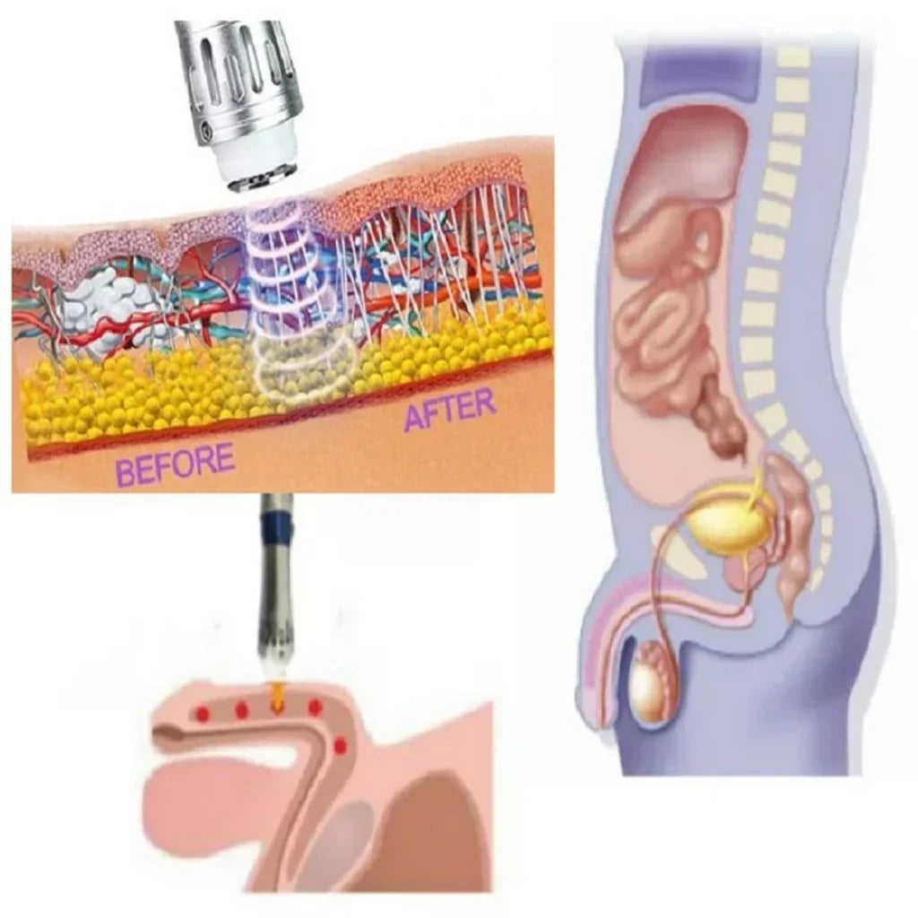 VitaPulse Portable ED Shockwave Therapy Device for Men — 10 Interchangeable Heads - Desfino
