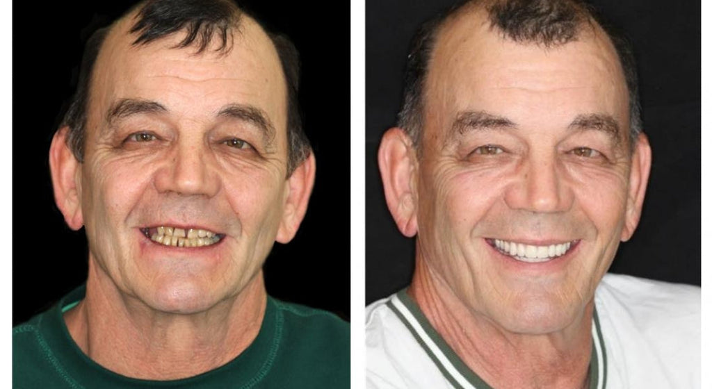 Prótesis dentales completas personalizadas LumaDent — Marfil y blanco, ajuste personalizado - Desfino