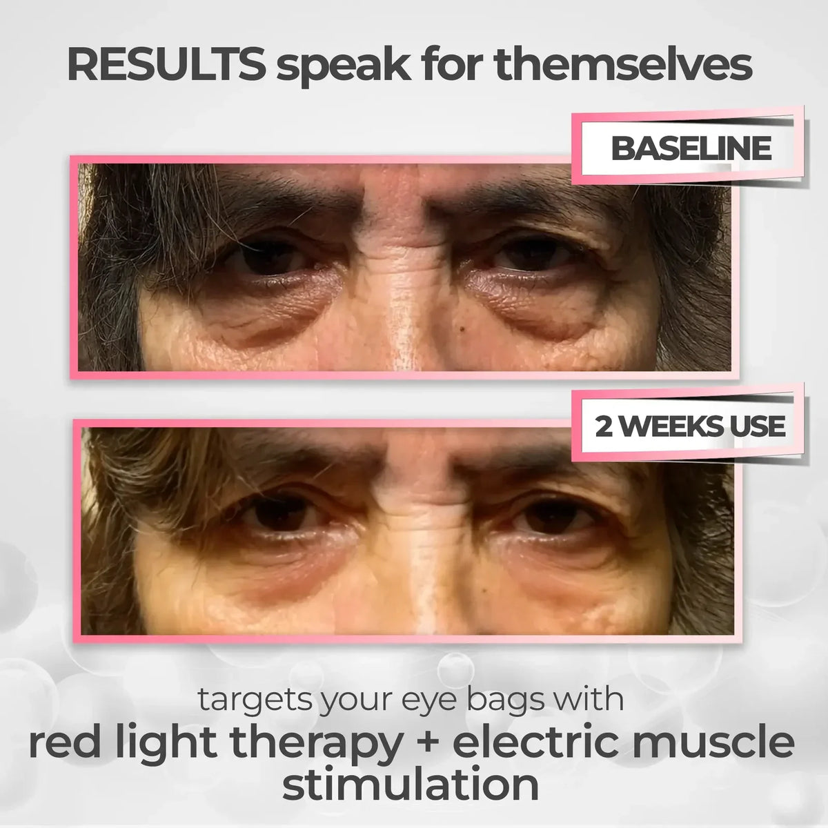 Système RadianceLift de 10 minutes à lumière rouge et microcourants pour le dessous des yeux - Desfino