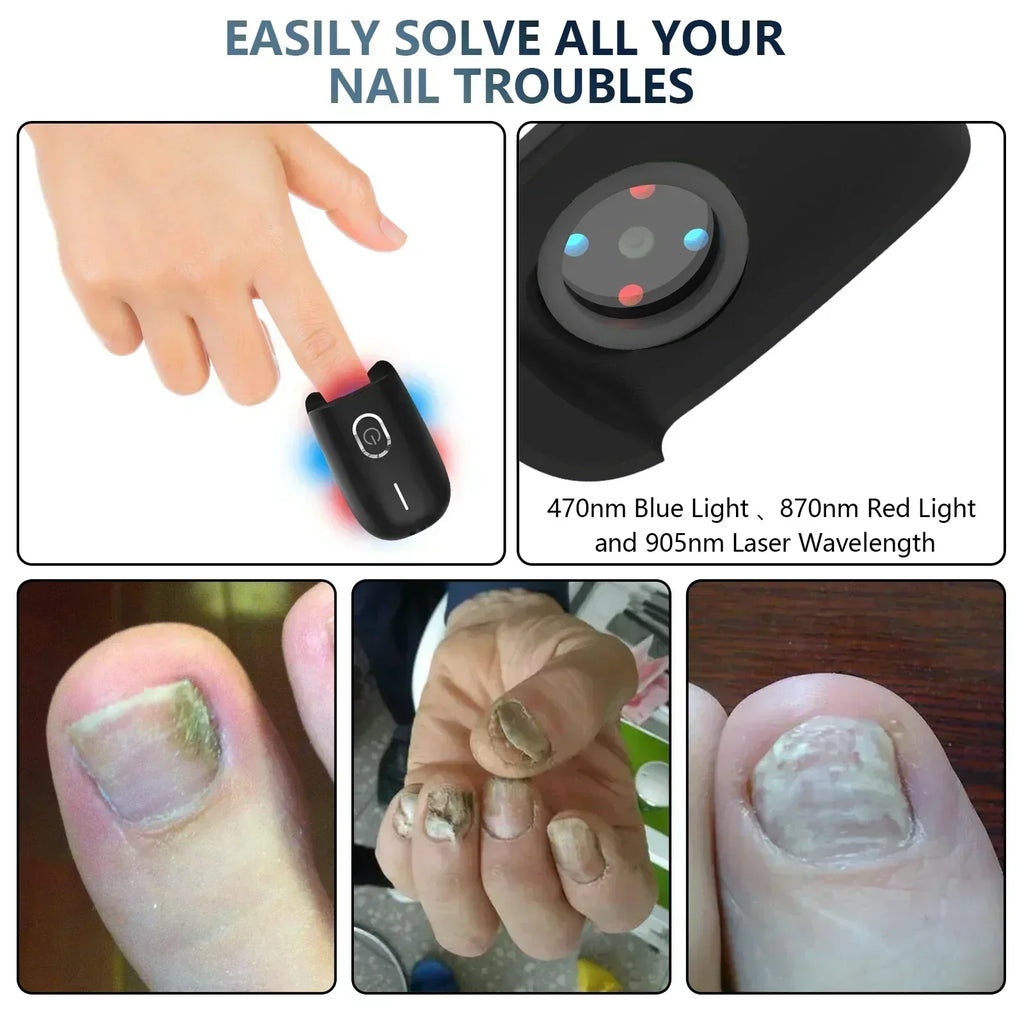 Dispositivo de terapia laser para unhas dos pés NovaNail com carregamento USB - Desfino