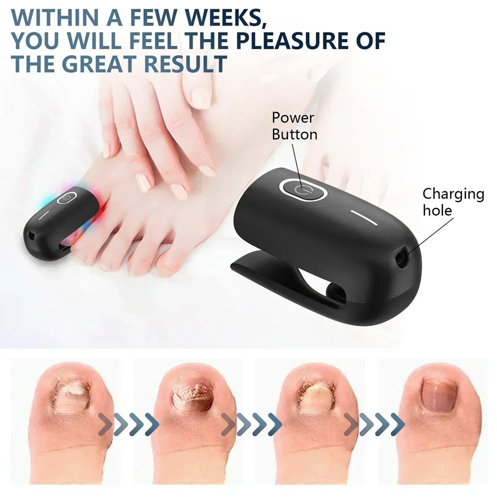 Dispositivo de terapia laser para unhas dos pés NovaNail com carregamento USB - Desfino