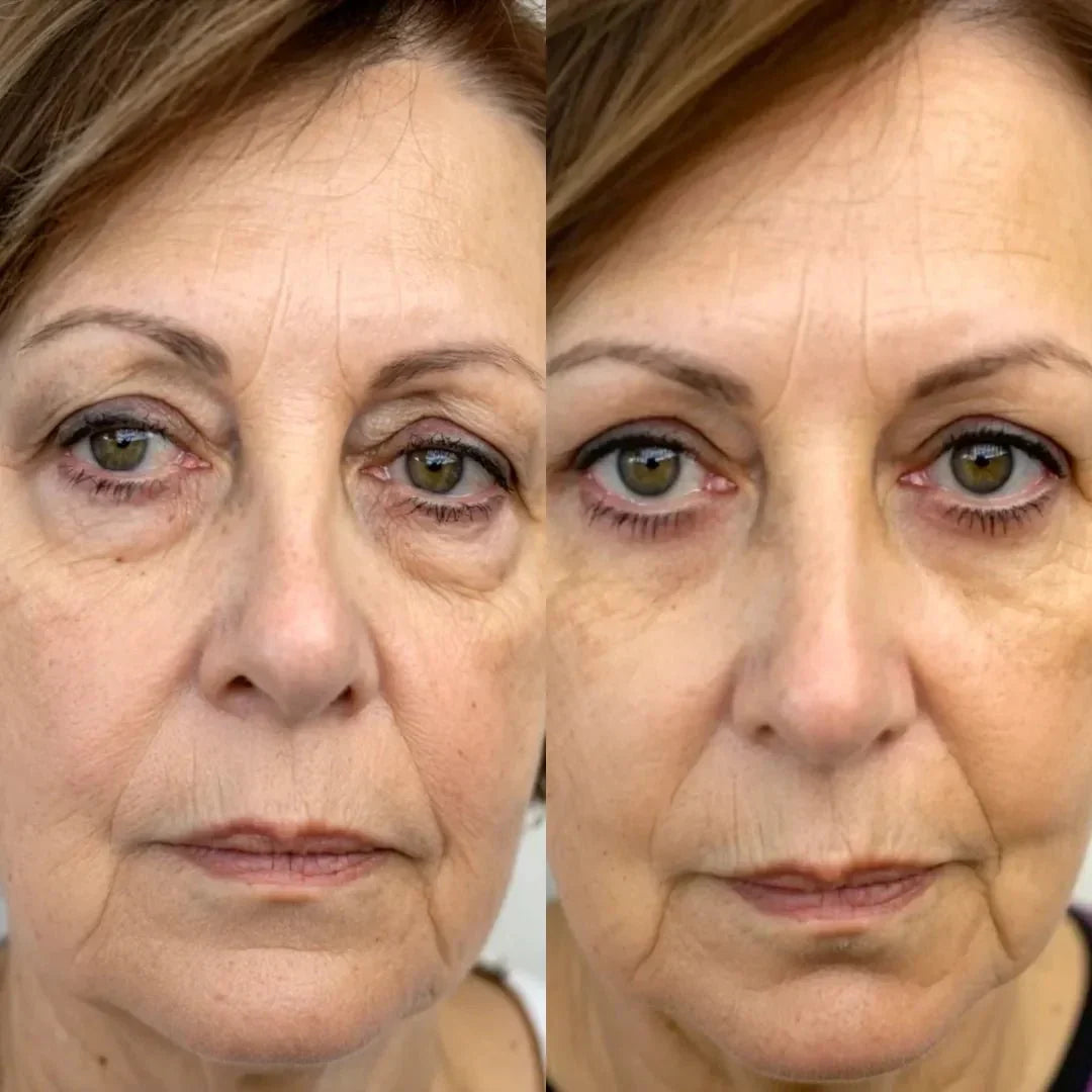 Système RadianceLift de 10 minutes à lumière rouge et microcourants pour le dessous des yeux - Desfino