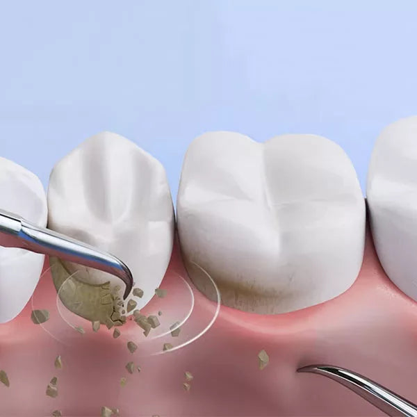 OralPro ultralydfjerner for plakk og tannstein — tannsteinrenser - Desfino
