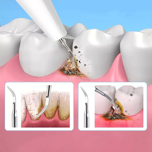Dispozitiv ultrasonic OralPro pentru îndepărtarea plăcii și a tartrului — curățător de tartru - Desfino