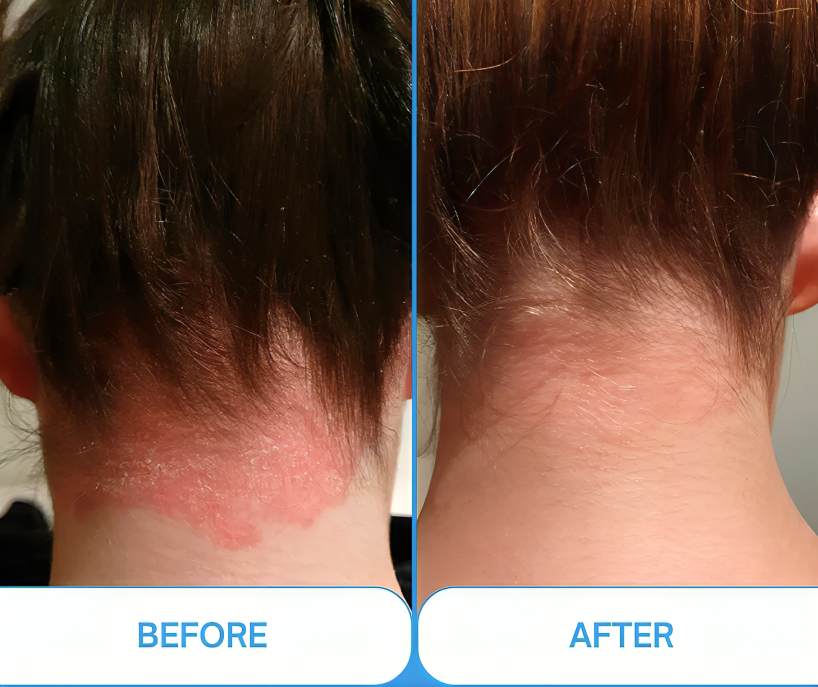 LumaNova 311 nm UVB-fototerapilampe i lommestørrelse — psoriasis, vitiligo - Desfino