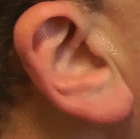Aparelhos auditivos recarregáveis Auralis Duo de perfil baixo — Design invisível intra-auricular