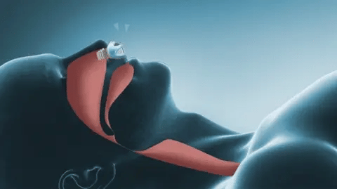 Nebula CPAP Nano — Dispositif anti-ronflement silencieux, compact et sans tuyau - Desfino