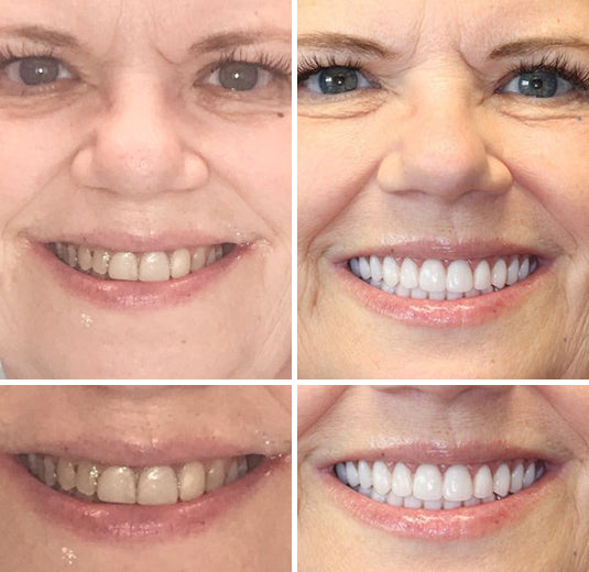 Prótesis dentales completas personalizadas LumaDent — Marfil y blanco, ajuste personalizado - Desfino
