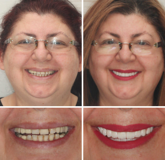 Prótesis dentales completas personalizadas LumaDent — Marfil y blanco, ajuste personalizado - Desfino