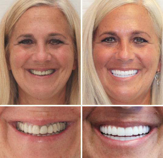 LumaDent Custom Full Dentures — Ivory & White, Personalized Fit - Desfino