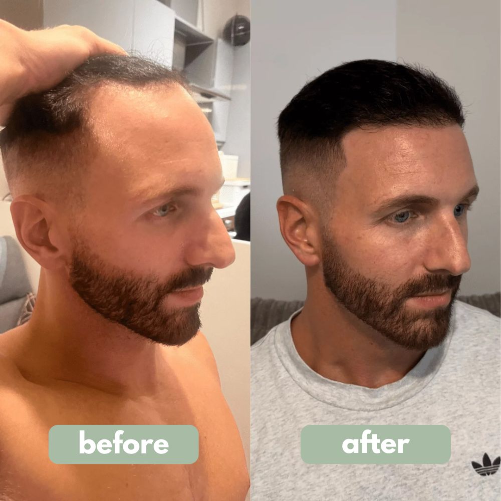 Pro-Growth Hair Revitalizing Roll-On — Lightweight Scalp Serum