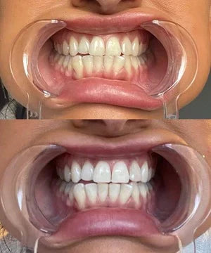רצועות להלבנת שיניים SmileGuard PAP+ לשיניים רגישות - Desfino