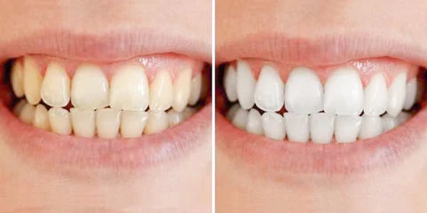Swift Teeth Whitening Treatment — Quick Visible Stain Removal - Desfino