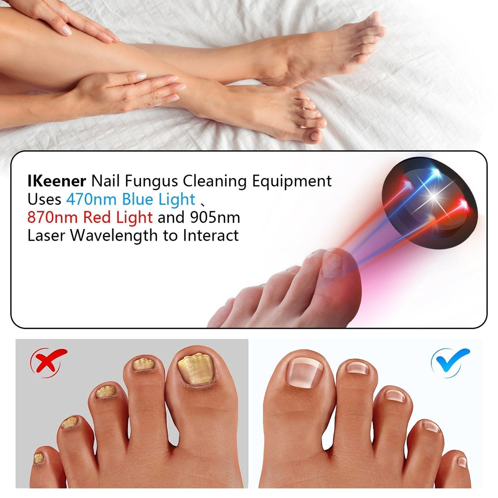 Dispositivo de terapia a laser para fungos nas unhas dos pés ApexNova — 910nm, 407nm - Desfino