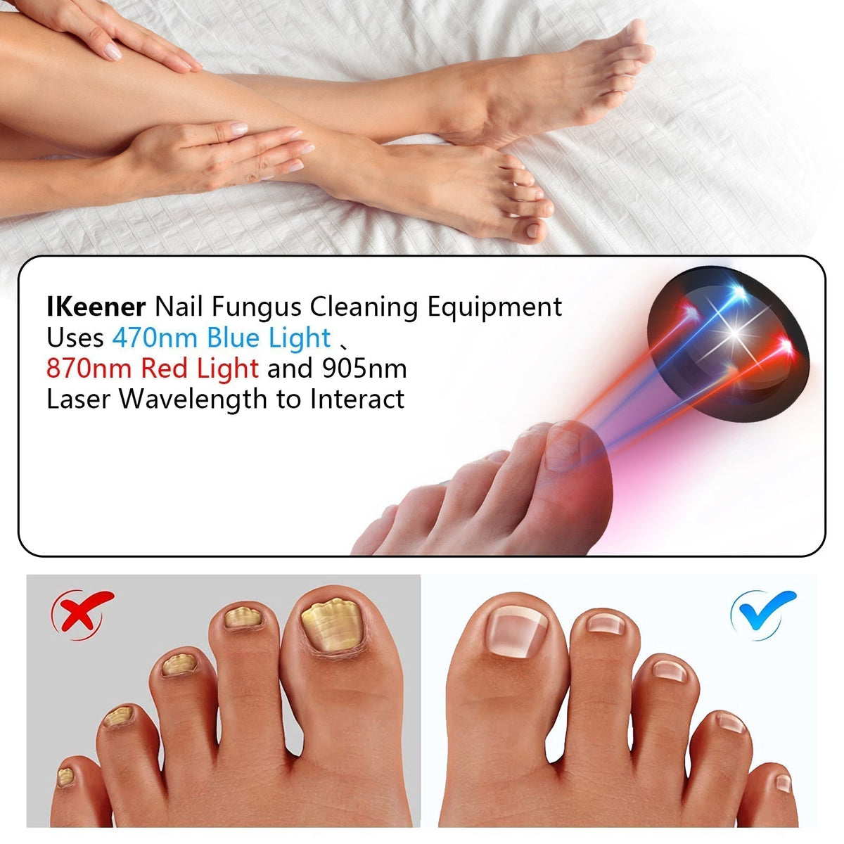 Dispositivo de terapia a laser para fungos nas unhas dos pés ApexNova — 910nm, 407nm - Desfino