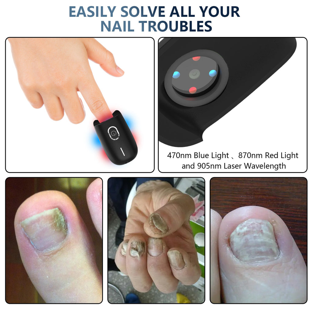 Dispositivo de terapia a laser para fungos nas unhas dos pés ApexNova — 910nm, 407nm - Desfino