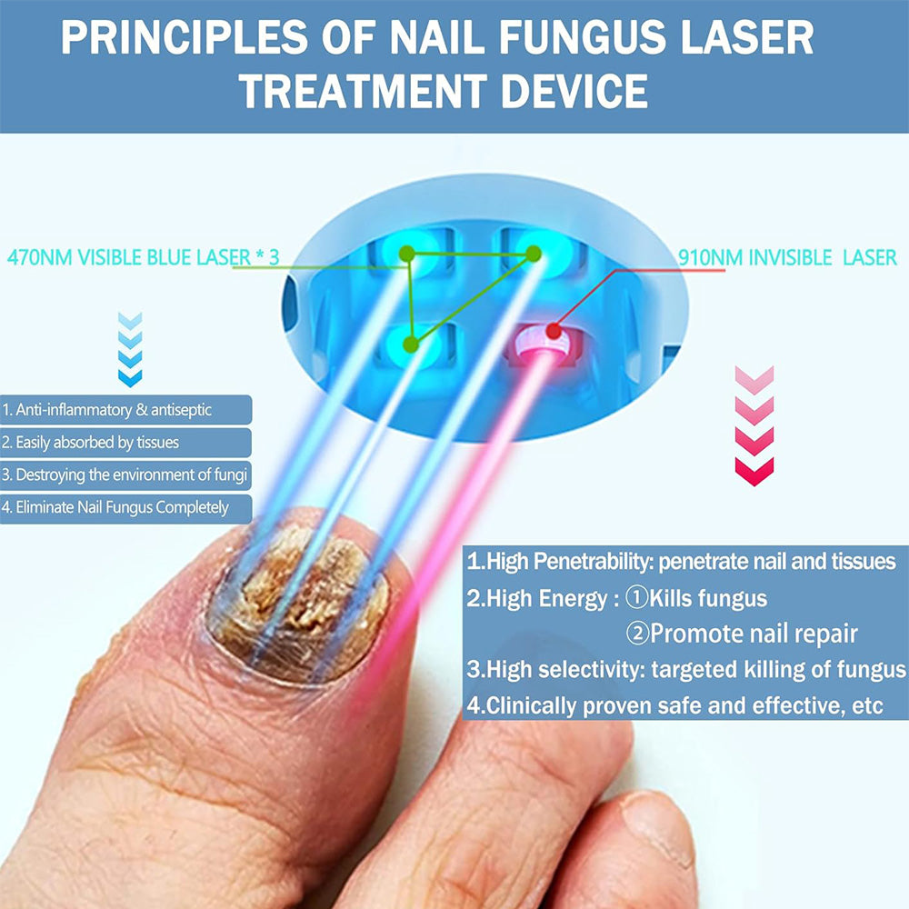 Dispozitiv laser profesional pentru ciuperca unghiilor de la picioare — lumină infraroșie de 910nm și lumină albastră de 407nm - Desfino