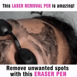 NovaDerm Picosecond Laser Pen — Tattoo, Mole, Freckle & Acne Removal - Desfino