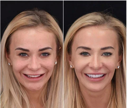 Facetas dentárias removíveis NovaSmile de encaixe para dentes superiores e inferiores - Desfino