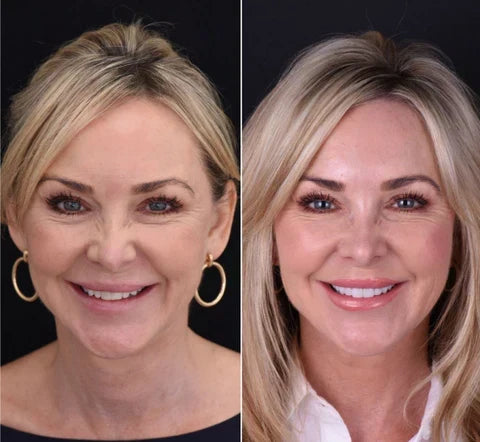 Facetas dentárias removíveis NovaSmile de encaixe para dentes superiores e inferiores - Desfino