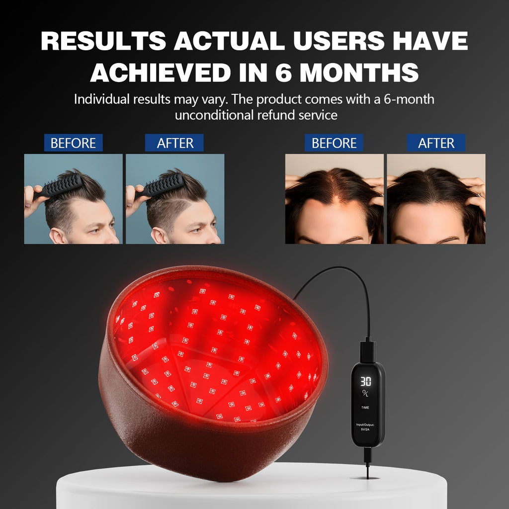 Casque laser portable contre la perte de densité capillaire — 82 diodes, séances de 30 minutes - Desfino